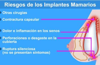 implantes de senos